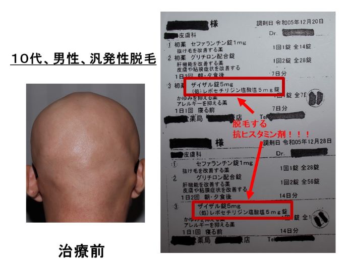 円形脱毛症　病院